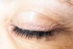 Eyelash Dandruff tips, Eyelash Dandruff symptoms, all about eyelash dandruff, Dandruff