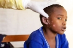 Monkeypox Outbreak cases, Monkeypox Outbreak new, is monkeypox outbreak coming to india, Mpox