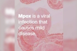 mpox in Congo, Health high alert, mpox emergency again, Mpox